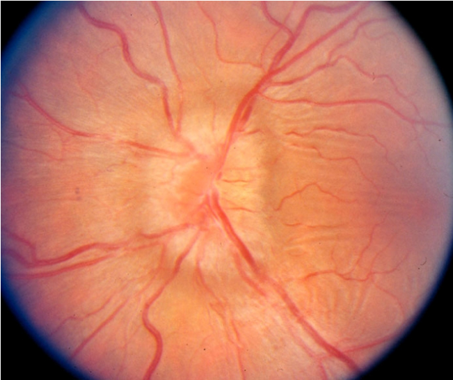 A 31-year-old woman comes to the office due to transient visual changes that are characterized by  loss of vision for a minute  and commonly precipitated by bending forward or lifting objects.  During the last 3 months, she has had persistent headaches that she attributes to migraines.  The patient takes over-the-counter analgesics as needed.  Blood pressure is 140/90 mm Hg and pulse is 72/min and regular.  BMI is 32.4 kg/m<sup>2</sup>.  Funduscopic findings of the left eye are shown in the image below, with similar findings in the right eye.   Which of the following is the most likely cause of the observed funduscopic findings in this patient? A) Choroidal inflammation B) Elevated intracranial pressure C) Elevated intraocular pressure D) Optic nerve inflammation E) Retinal ischemia