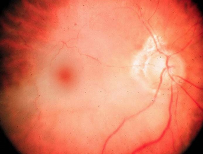 A 64-year-old man comes to the emergency department due to painless loss of vision in the right eye.  The patient's symptoms started suddenly several hours ago and have persisted.  He has had no trauma or any similar episode in the past.  He has a history of coronary artery disease, atrial fibrillation, and type 2 diabetes mellitus.  Blood pressure is 144/86 mm Hg and pulse is 92/min.  Cardiovascular examination reveals irregularly irregular rhythm with no murmurs, no peripheral edema, and slightly diminished pedal pulses in both feet symmetrically.  Visual acuity in the right eye is hand motion only and normal in the left eye.  Funduscopic examination of the right eye is shown in the image below.   Which of the following is the most likely cause of this patient's loss of vision? A) Amaurosis fugax B) Diabetic retinopathy C) Pituitary adenoma D) Retinal artery occlusion E) Temporal lobe stroke