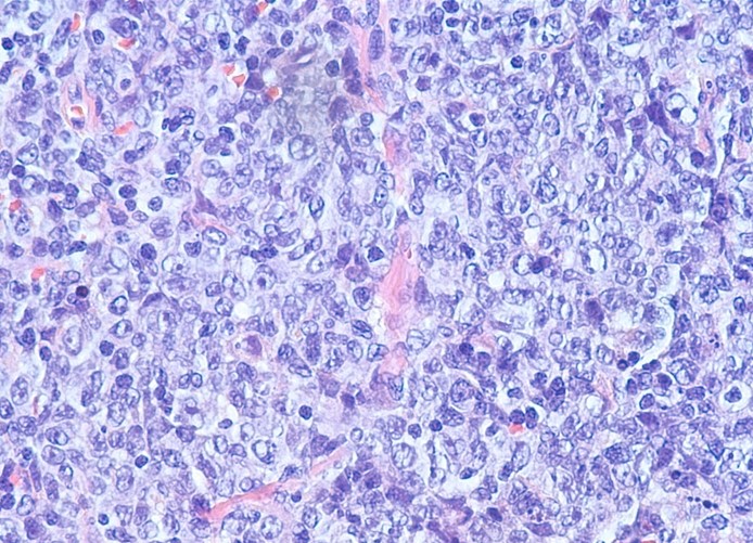 A 13-year-old boy is admitted to the hospital due to fever and fatigue for the past week.  The patient recently received a cadaveric renal transplant for glomerulonephritis, and his immunosuppressive medication regimen was increased a month ago due to early evidence of rejection.  Temperature is 37.7 C (99.9 F) .  Heart and lung examinations are unremarkable.  The liver is mildly enlarged, and the spleen tip is palpable.  There is notable adenopathy of the bilateral inguinal and axillary regions.  A complete blood count shows mild leukopenia.  Histopathology findings from biopsy of one of the enlarged lymph nodes are shown in the image below.   Which of the following is the most likely cause of this patient's presentation? A) Aspergillus fumigatus B) Bartonella henselae C) Cryptococcus neoformans D) Epstein-Barr virus E) Parvovirus B19