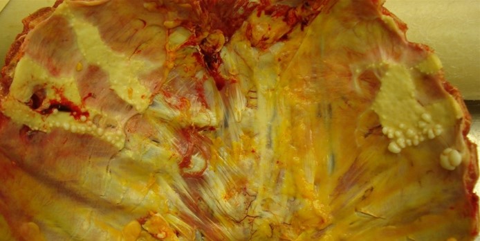 A 76-year-old man is brought to the emergency department after being involved in a motor vehicle collision.  He is found to have a laceration of the spleen and is taken for emergent laparotomy.  During surgery, the patient goes into cardiac arrest and dies, despite aggressive resuscitation efforts.  Autopsy examination is performed and shows areas of thickening inside the chest wall as shown below.   Lung examination shows fibrosis of the lower lobes.  Pathologic examination of these fibrotic areas is most likely to reveal which of the following findings? A) Alveolar hyaline membranes B) Birefringent silicate particles C) Carbon-laden macrophages D) Cells with dense-core granules E) Coalescence of granulomas F) Ferruginous bodies