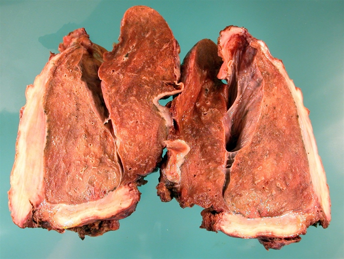 A 76-year-old man has had worsening shortness of breath, cough, and weight loss for the past several months.  He is a lifelong nonsmoker.  Chest imaging reveals irregular pleural thickening.  A surgical biopsy is planned, but the patient refuses, choosing to receive hospice care instead.  He dies several weeks later.  Autopsy examination is performed, and a photograph of the cut lung section is shown below.   Histopathological examination of the abnormal tissue is most likely to reveal which of the following findings? A) Caseating granulomas with giant cells B) Central areas of whorled collagen fibers C) Small round cells positive for chromogranin D) Spindle cells positive for cytokeratin E) Thick, fibrinous exudate and pus