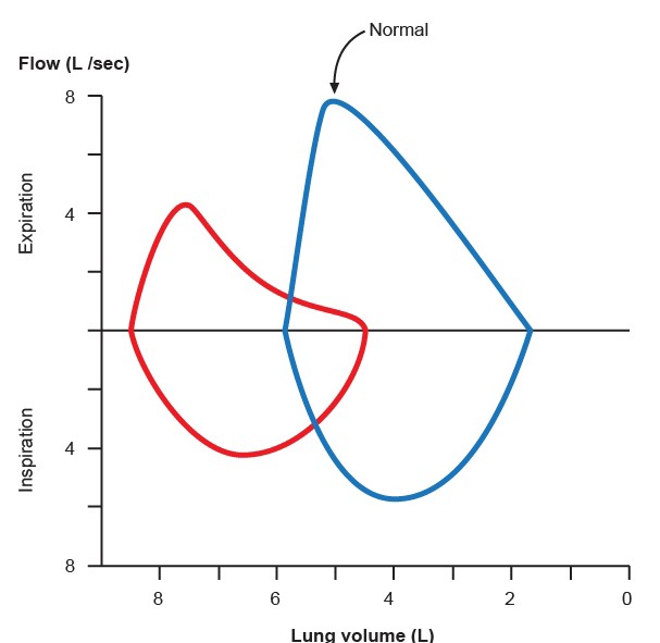 A 57-year-old man is being evaluated for progressive shortness of breath.  His respiratory flow-volume curve is shown in red below.   Which of the following pathologic findings is most likely to be present in this patient? A) Alveolar hyaline membranes B) Compression atelectasis C) Interalveolar wall destruction D) Intraalveolar hemorrhage E) Pulmonary fibrosis F) Thromboembolic disease