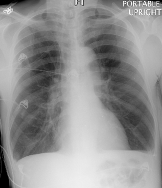 A 62-year-old man comes to the office due to shortness of breath.  His symptoms have progressed over the last few months and have begun to limit his daily activities.  He has no other medical problems and takes no medications.  The patient drinks 3 or 4 alcoholic beverages a week and has a 50-pack-year smoking history.  Physical examination reveals decreased breath sounds and scattered wheezes bilaterally.  Chest x-ray is shown below.   Which of the following parameters is most likely to be increased in this patient? A) Carbon monoxide diffusion capacity B) Expiratory flow rates C) Forced vital capacity D) Functional residual capacity E) Lung elastic recoil