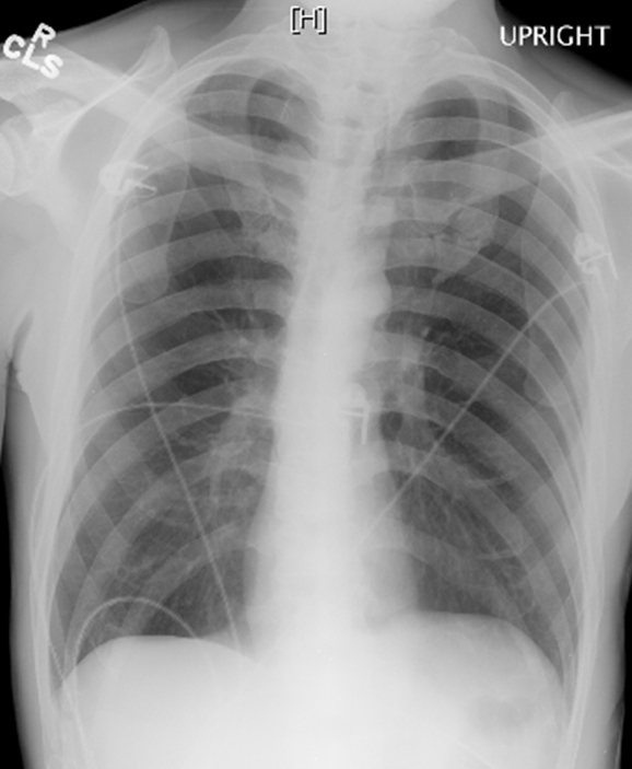 A 68-year-old man comes to the office for gradually increasing shortness of breath.  He initially experienced symptoms with exertion but now feels short of breath at rest.  The patient has smoked 2 packs of cigarettes per day for 40 years.  Blood pressure is 138/78 mm Hg, pulse is 80/min, and respirations are 22/min.  The chest x-ray is shown in the image below:   Which of the following measures is most likely increased in this patient? A) Diffusing capacity of the lung for carbon monoxide B) Forced expiratory volume in 1 second C) Forced expiratory volume in 1 second/forced vital capacity ratio D) Forced vital capacity E) Residual volume/total lung capacity ratio