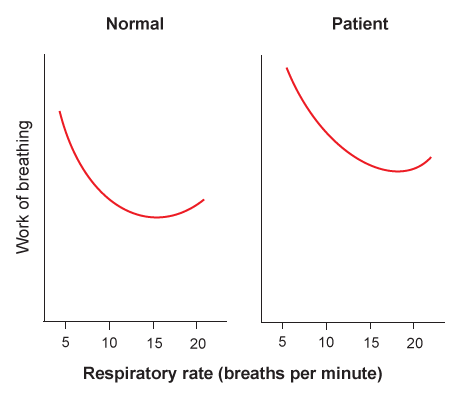 A 53-year-old man is being evaluated for dyspnea.  The graph on the right shows how the patient's work of breathing varies with respiratory rate, whereas the graph on left represents the work of breathing versus respiratory rate in a normal individual.  The minute ventilation is constant and equal in both graphs.   Which of the following is the most likely diagnosis in this patient? A) Alpha-1 antitrypsin deficiency B) Anxiety disorder C) Asthma D) Goiter E) Pulmonary fibrosis