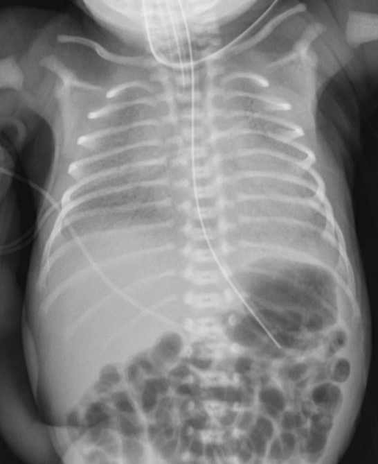 A 4-hour-old girl is evaluated in the neonatal intensive care unit.  The patient was born at 30 weeks gestation via spontaneous vaginal delivery after 3 hours of labor.  Membranes ruptured at the onset of labor and amniotic fluid appeared clear.  Immediately after birth, the child was placed on continuous positive airway pressure by nasal prongs due to signs of breathing difficulty.  Temperature is 36.7 C (98 F) , pulse is 158/min, and respirations are 54/min.  Pulse oximetry is 92% on 60% oxygen.  Examination shows audible grunting and subcostal chest wall retractions.  Cardiac examination shows no murmurs.  A chest x-ray is obtained:   The radiographic findings in this patient most likely represent which of the following? A) Air leakage into pleural space B) Alveolar and capillary dysplasia C) Diffuse atelectasis D) Occlusion of the bronchioles E) Retained extracellular fluid