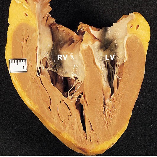 A 32-year-old woman comes to the emergency department with lightheadedness and shortness of breath, which started while shopping at a supermarket.  During the last 6 months, she had increasing shortness of breath and had to adjust her daily activities.  The patient has no other medical problems and does not use tobacco, alcohol, or illicit drugs.  There is no family history of heart disease, stroke, or blood clots.  Her BMI is 25 kg/m<sup>2</sup>.  After initial assessment, the patient reports that she feels  fine,  refuses further evaluation, and insists on being discharged.  She dies a month later.  At autopsy, her heart has the following appearance (RV, right ventricle; LV, left ventricle) :   Which of the following is the most likely diagnosis? A) Bicuspid aortic valve with acquired aortic stenosis B) Dilated cardiomyopathy C) Essential hypertension D) Myocardial infarction E) Pulmonary arterial hypertension F) Wolff-Parkinson-White syndrome