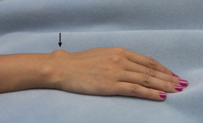 A 17-year-old girl is brought to the office for evaluation of a right wrist mass.  She noticed swelling on the top of her wrist approximately 3 months ago but said that it did not bother her until she was teased about it in school.  She has no other concerns.  Examination shows a nontender, rounded mass on the dorsal wrist that transilluminates with a penlight.  An image of the mass is shown below:   Which of the following is the most likely underlying etiology? A) Benign proliferation of fat cells B) Degeneration of periarticular tissue C) Immune-mediated joint destruction D) Malignant transformation of synovial tissue E) Uric acid crystal deposition