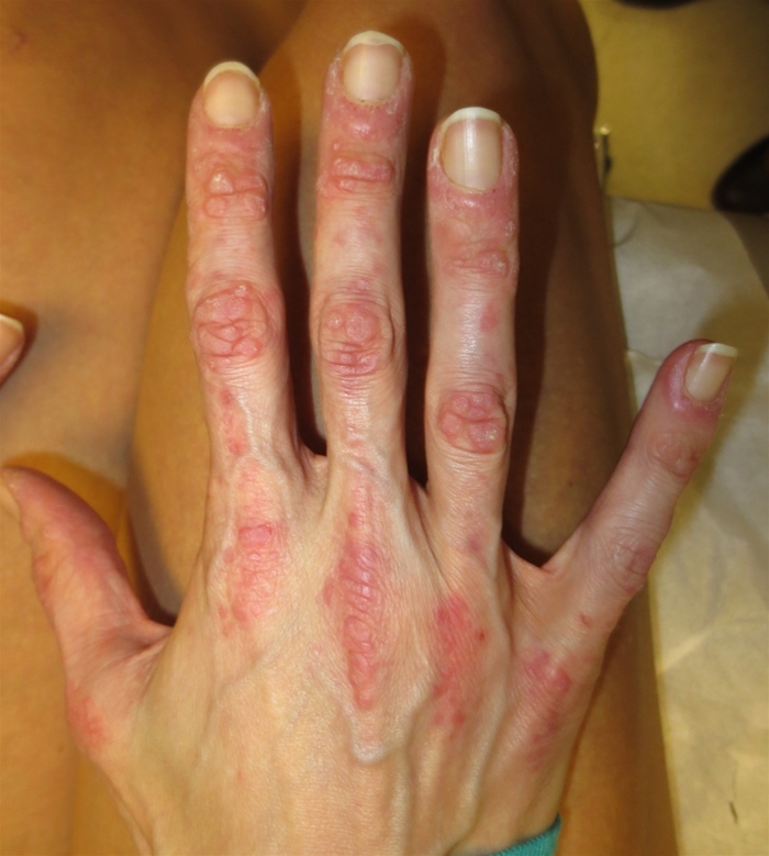 A 48-year-old previously healthy woman comes to the office due to progressively worsening muscle weakness for the past 2 months.  The patient has difficulty with activities such as climbing stairs, getting up from chairs, and placing dishes in overhead cabinets.  She also reports a 4.5-kg (10-lb)  unintentional weight loss and occasional abdominal discomfort over the same interval.  Physical examination shows weakness of the shoulder and hip girdle muscles.  Other examination findings are shown in the image below.   Further evaluation of this patient is most likely to reveal which of the following associated conditions? A) Chronic hepatitis C infection B) Ovarian adenocarcinoma C) Primary biliary cholangitis D) Tropheryma whippelii infection E) Type 2 diabetes mellitus