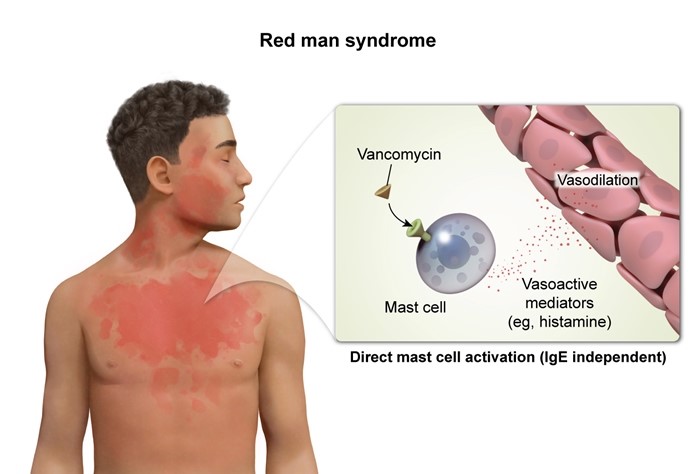 C   This patient was given vancomycin and shortly thereafter developed burning, itching, and an erythematous rash on the face and neck, raising strong suspicion for <strong>red man syndrome</strong> (RMS).  RMS is a <strong>nonallergic reaction</strong> that occurs when vancomycin is infused too <strong>rapidly</strong>; rapid vancomycin infusion can <strong>directly activate mast cells</strong>, leading to the release of potent vasoactive mediators (eg, <strong>histamine</strong>). Manifestations of RMS include flushing, pruritus, and an erythematous rash, which is usually seen on the upper torso, neck, and face.  Myalgias and hypotension can occasionally occur.  Discontinuation of the vancomycin and administration of diphenhydramine are usually curative.  Because RMS is <strong>not IgE mediated</strong>, it is not a true allergic reaction, so vancomycin infusion can be resumed at a <strong>slower rate</strong> once symptoms resolve. <strong>(Choice A)</strong>  Patients with spirochetal illness (eg, syphilis, Lyme disease) can develop the Jarisch-Herxheimer reaction after the initiation of antimicrobial therapy.  It is caused by massive release of bacterial products into the circulation due to widespread bacterial lysis.  However, most cases arise several hours (not minutes) after antimicrobial therapy and are marked by high fever and worsened constitutional symptoms (eg, headache, myalgia). <strong>(Choices B and D)</strong>  Antibody-mediated drug reactions generally require previous exposure (sensitization) to the medication.  This patient who has never received vancomycin is unlikely to have an antibody-mediated reaction; furthermore, such reactions are rare with vancomycin and are usually marked by urticaria, pruritus, hypotension, and angioedema. <strong>(Choice E)</strong>  Serotonergic drug interactions are most common with drugs that affect the serotonin system such as selective serotonin reuptake inhibitors, tricyclic antidepressants, and certain antiemetics (eg, ondansetron).  However, most cases are marked by alterations in autonomic function (eg, hypertension, tachycardia, hyperthermia), and rash is unusual. <strong>Educational objective:</strong> Red man syndrome (RMS) is the most common adverse reaction to vancomycin.  It occurs due to rapid vancomycin infusion, which leads to the direct activation of mast cells and the subsequent release of vasoactive mediators.  Patients develop flushing, pruritus, and an erythematous rash on the upper torso, face, and neck within minutes of initiation.  Because RMS is not a true allergic reaction (not IgE mediated), vancomycin can be restarted at a slower rate of infusion once symptoms resolve.