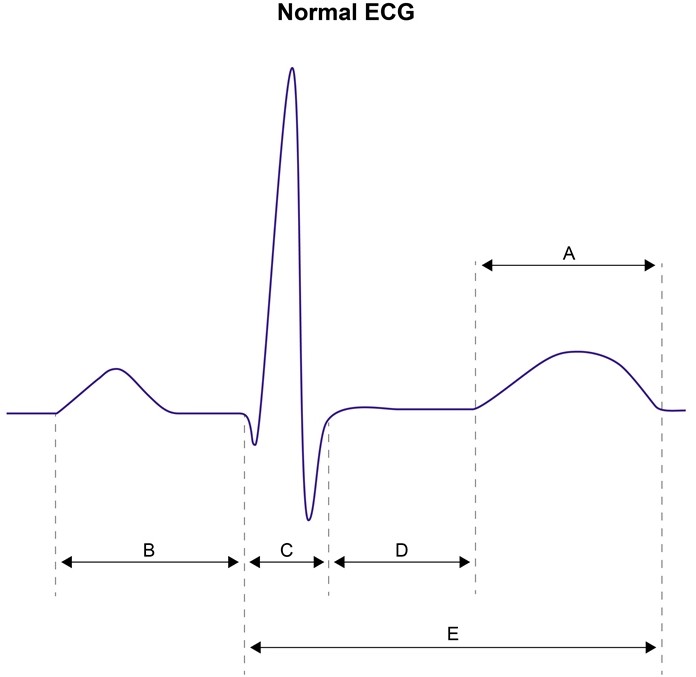 <strong>A 47-year-old man with known coronary artery disease comes to the emergency department with chest tightness, sweating, and palpitations. His symptoms began abruptly 2 hours ago while he was at work. Six months ago, the patient underwent percutaneous angioplasty of the right coronary artery. Past medical history also includes anxiety and panic attacks. Blood pressure is 180/90 mm Hg and pulse is 110/min with a regular rhythm. An esmolol infusion produces rapid symptom relief and heart rate slowing. Which of the following portions of the ECG will be affected most significantly by the medication? </strong> A)A B)B C)C D)D E)E