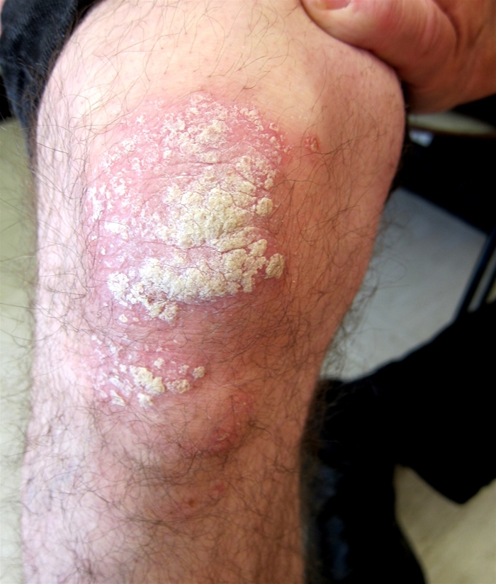 A 27-year-old man comes to the office for evaluation of a rash on both knees.  The patient first noticed the rash 2 months ago.  He has no other medical conditions and takes no medications.  The patient smokes a half pack of cigarettes daily.  Vital signs are normal.  His knee is shown in the image below:   Removal of the scale results in small bleeding points.  As part of the treatment regimen, a topical vitamin D analog is prescribed.  This medication is most likely to improve this patient's condition via which of the following mechanisms? A) Decreased activity of tyrosinase enzyme B) Decreased levels of irritating fatty acids C) Increased production of dermal cytokines D) Inhibition of dermal cyclooxygenase E) Inhibition of keratinocyte proliferation