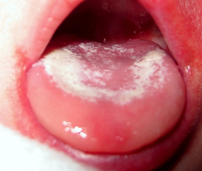 A 6-year-old asthmatic has the finding shown in the image below on routine examination.   Which of the following is the most appropriate pharmacotherapy for the lesions on this patient's oral mucosa? A) Acyclovir B) Amphotericin-B C) Griseofulvin D) Nystatin E) Penicillin F) Terbinafine