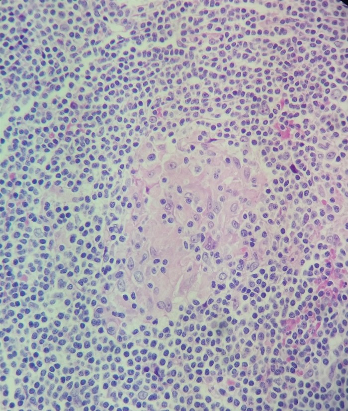 A 28-year-old man comes to the emergency department due to progressive abdominal pain.  Although he has had mild abdominal cramps in the past, he has never before experienced anything this severe.  The patient has 8-10 watery stools a day, weight loss, fatigue, and lethargy.  Temperature is 38.3 C (100.9 F) , blood pressure is 125/82 mm Hg, pulse is 95/min, and respirations are 14/min.  The abdomen is tender to palpation without rebound or guarding.  Abdominal CT scan reveals inflammatory changes affecting the ascending colon, sigmoid colon, and terminal ileum.  Intestinal biopsy reveals the following:   Effective treatment of this patient's condition could be achieved by targeting which of the following molecules? A) BCR-ABL protein tyrosine kinase B) CD20 lymphocyte antigen C) mTOR protein kinase D) Programmed cell death-1 protein E) Tumor necrosis factor-alpha