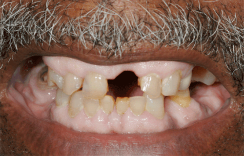 A 43-year-old male with multiple medical problems including seizure disorder and mental illness comes to your office for the first time in order to establish a primary care physician.  On routine physical examination, you notice the findings shown in the photo below.   Which of the following is most likely responsible for the condition of this patient's teeth and gums? A) Phenytoin B) Lithium C) Prednisone D) Cocaine E) Methimazole F) Clozapine