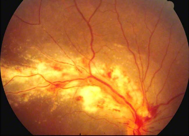 A 43-year-old man comes to the emergency department due to painless, progressive visual impairment.  The patient was diagnosed with sexually acquired HIV infection 4 years ago.  He was previously started on antiretroviral therapy but has been noncompliant with his prescribed medications.  His most recent CD4 count was 37 cells/mm<sup>3</sup>.  Physical examination shows no skin rash or corneal lesions.  Funduscopy reveals the findings seen in the image below.   Which of the following medications is the best initial therapy for this patient? A) Acyclovir B) Amphotericin B C) Clarithromycin D) Flucytosine E) Ganciclovir F) Penicillin G