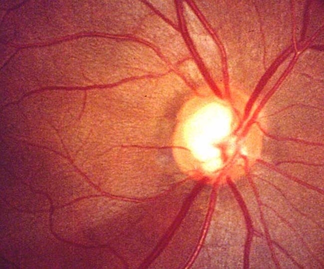 A 58-year-old airline captain comes to the office after he was found to have abnormal vision testing during a pilot medical certification examination.  The patient feels well and has no ocular symptoms.  Vision testing shows normal visual acuity but moderate loss of peripheral vision in both eyes.  Results of the funduscopic examination are shown in the image below.   Other neurologic and cardiopulmonary examination findings are unremarkable.  He is started on latanoprost eyedrops.  The medication is most likely to improve this patient's condition through which of the following mechanisms? A) Decreased bicarbonate formation in ciliary body B) Decreased formation of abnormal blood vessels in retina C) Decreased secretion of aqueous humor D) Increased outflow of aqueous humor E) Vasoconstriction in ciliary body