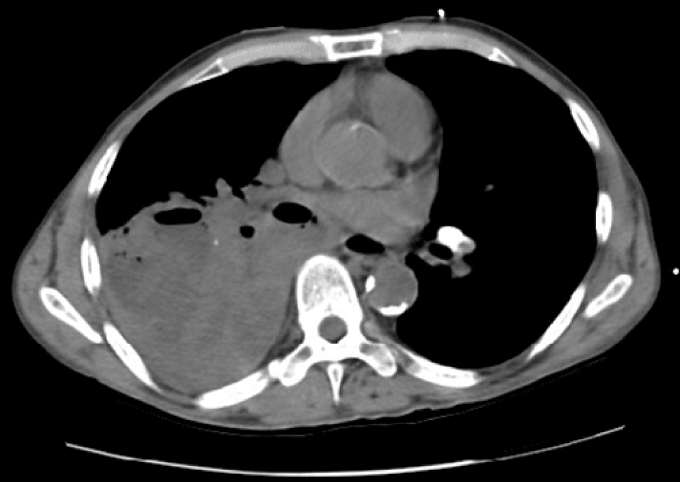 A 41-year-old man comes to the emergency department due to 3 weeks of low-grade fever, productive cough, and a 4.5-kg (10-lb)  weight loss.  The patient drinks 10-12 beers a day.  On physical examination, he appears cachectic.  Poor dentition and clubbing of the fingers are noted.  A foul-smelling sputum sample is expectorated and sent for Gram stain and culture.  CT scan of the chest is shown in the image below:   Empiric antimicrobial therapy should include coverage against which of the following pathogens? A) Cell wall-deficient bacteria B) Intestinal gram-negative flora C) Resident skin microbiota D) Staphylococci resistant to beta-lactams E) Strict and facultative anaerobes
