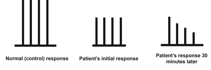 A 63-year-old man hospitalized for chronic obstructive pulmonary disease exacerbation develops hypercapnic respiratory failure.  He is transferred to the intensive care unit, where he undergoes intubation after premedication with muscle relaxant X and an appropriate sedative.  The patient is then started on mechanical ventilation; however, he remains apneic longer than expected.  Anesthesiology is consulted, and the patient's neuromuscular blockade is assessed by electrically stimulating a peripheral nerve 4 times in quick succession and observing the muscular response.  The procedure is repeated 30 minutes later and the results are shown below.   Muscle relaxant X is most likely to be which of the following medications? A) Dantrolene B) Midazolam C) Pancuronium D) Succinylcholine E) Tubocurarine