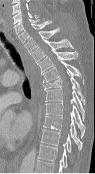 A 48-year-old woman comes to the emergency department due to back pain after minor trauma.  She has no leg weakness or numbness.  Review of systems is positive for recent-onset hot flashes and irregular menses; her most recent menstruation was 2 weeks ago.  The patient has a long history of hypothyroidism treated with levothyroxine and rheumatoid arthritis treated with methotrexate.  She has also taken oral prednisone for frequent symptom flares.  The patient does not use tobacco, alcohol, or illicit drugs, and she consumes a balanced diet.  Physical examination shows point tenderness over the midthoracic spine.  The straight-leg raising test is negative, and neurologic examination of the lower extremities shows no abnormalities.  Spine imaging is shown below:   Which of the following contributed most to this patient's current condition? A) Inadequate levothyroxine replacement B) Medication adverse effect C) Nutritional vitamin deficiency D) Ovarian hormone deficiency E) Vertebral joint inflammation