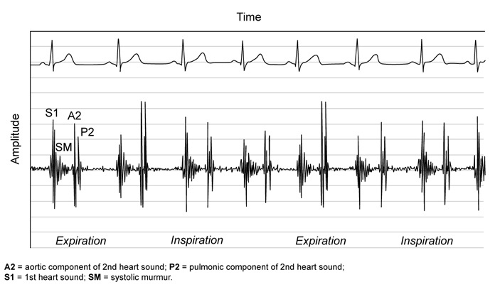 <strong>A 14-year-old girl is brought to the office to establish medical care. The patient recently immigrated to the United States with her parents from Vietnam. Vital signs are within normal limits. Phonocardiogram obtained at the left upper sternal border is shown below. Which of the following is the most likely underlying cause of this patient's heart murmur?</strong> A)Abnormal narrowing of the aortic valve B)Incomplete ventricular septum development C)Increased pulmonary blood flow D)Regurgitation of blood from the aorta
