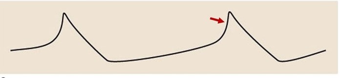 <strong>Special electrodes are used to detect the change in membrane potential of a specific type of cardiac cell. These changes are recorded on the graph below. The deflection indicated by the arrow is most likely caused by movement of which of the following ions?</strong> A)Sodium B)Potassium C)Calcium D)Chloride E)Sodium and potassium F)Calcium and potassium