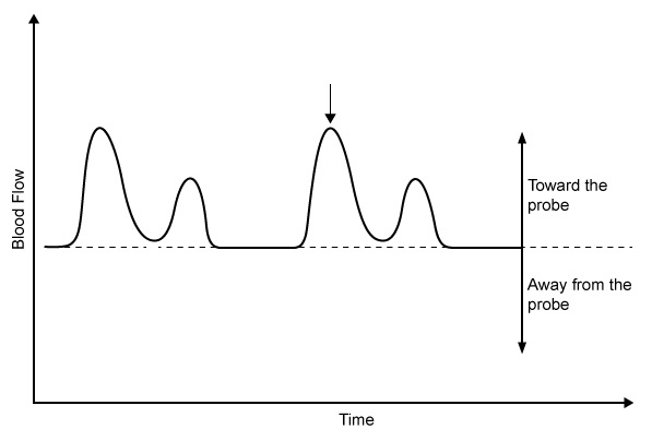 <strong>A 52-year-old man comes to the office with a 2-week history of shortness of breath and dry cough. The patient has noticed decreased exercise tolerance that limits his daily activities. A Doppler probe placed at the cardiac apex reveals the following blood flow pattern across the patient's mitral valve. The point marked by the arrow would best correspond to which of the following auscultation findings?</strong> A)Fourth heart sound B)Midsystolic click C)Second heart sound D)Third heart sound