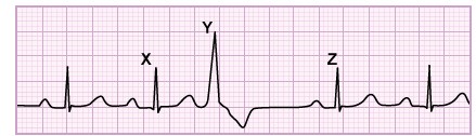 <strong>A 45-year-old woman participates in a cardiovascular health study. She undergoes continuous 24-hour ECG monitoring with a wearable device. A few instances of the following pattern were found on her ECG: Which of the following best represents the relative left ventricular end-diastolic volumes just prior to the heart beats represented by the letters?</strong> A)X=Y=Z B)X>Y>Z C)Y>X>Z D)Y=Z>X E)Z>X>Y