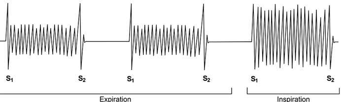 <strong>A 35-year-old woman comes to the office for a follow-up appointment after recent hospitalization. The patient presented to the emergency department with fever and malaise and was diagnosed with infective endocarditis. She underwent a prolonged course of antibiotic therapy and her last dose was 5 days ago. She has no fever or shortness of breath and has resumed her daily activities. The patient has no other medical problems. Blood pressure is 128/72 mm Hg and pulse is 78/min. Auscultatory findings recorded at the left sternal border are shown in the phonocardiogram below. Which of the following is the most likely cause of the murmur depicted above?</strong> A)Aortic stenosis B)Mitral regurgitation C)Mitral stenosis D)Pulmonary regurgitation E)Tricuspid regurgitation