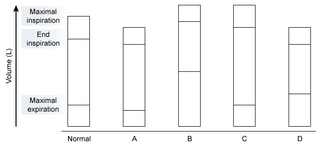 <strong>A 64-year-old man is examined because his dyspnea becomes worse with exercise. He's smoked 40 packs in the past 40 years. On percussion, the lungs are hyperresonant, and on auscultation, there is generalized wheezing. On a chest x-ray, the diaphragm is flattened, the mediastinum is thin, and the peripheral lung region has fewer bronchovascular signs. Which of the following trends for lung volume in this patient is more likely? (Each bar represents total lung capacity with different volumes as marked.) </strong> A)A B)B C)C D)D
