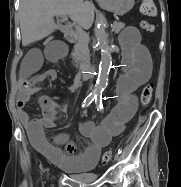 <strong>A 67-year-old woman is admitted to the hospital due to worsening abdominal pain. The patient has long-term end-stage renal disease caused by diabetic nephropathy, for which she receives hemodialysis three times per week. The temperature is 37 degrees Celsius (98.6 degrees F), the blood pressure is 159/79 mm Hg, the pulse rate is 97 bpm, and the respirations rate is 16 /minute. High-pitched bowel sounds and mild distension without rebound tenderness are seen on abdominal examination. Blood urea nitrogen and creatinine levels are elevated, according to laboratory results. A small bowel obstruction is visible on a noncontrast CT scan of the abdomen. The arrows in the abdominal CT scan below show the following findings in the patient:   Which of the following most likely contributed to the observed findings?</strong> A)Hypermagnesemia B)Hyperphosphatemia C)Hypocalcemia D)Hypophosphatemia E)Recurrent hypoglycemia <div style=padding-top: 35px> 