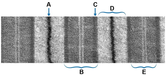 An 8-year-old boy is evaluated in the office due to difficulty walking.  The patient has problems running, jumping, and walking up steps.  There is no history of neurological disorders in the family.  Physical examination reveals weakness of lower extremity muscles bilaterally.  Electron microscopy of a biopsy sample taken from calf muscle is shown below.   Which of the following labeled regions contains only thick filaments and no thin filaments? A) A B) B C) C D) D E) E