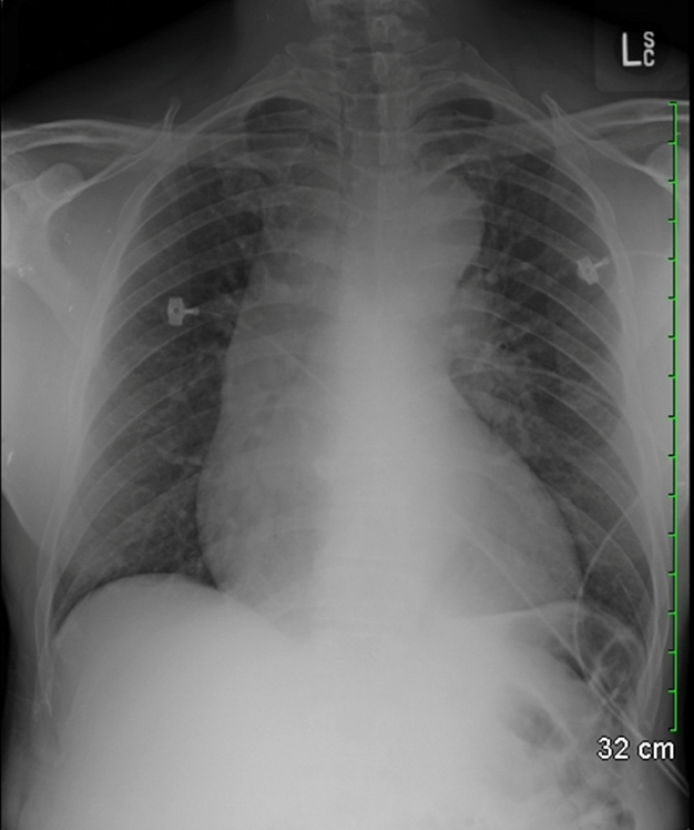 <strong>A 54-year-old man comes to the emergency department with severe chest and neck pain that started 2 hours ago.  His past medical history is significant for hypertension treated with amlodipine and irbesartan.  His father died suddenly at the age of 43 years.  He does not smoke or use illicit drugs. His blood pressure is 162/100 mmHg and pulse is 101/min.  He appears mildly uncomfortable due to pain. EKG shows sinus tachycardia, voltage criteria for left ventricular hypertrophy, and T wave inversions in leads V5 and V6.  Chest x-ray findings are shown below.   He is initially treated with nitroglycerin. What is the best next step in managing this patient?</strong> A)Aspirin and clopidogrel B)Cardiac catheterization C)Chest tube D)CT angiogram E)Repeat EKG in 30 min and cardiac enzymes <div style=padding-top: 35px> 