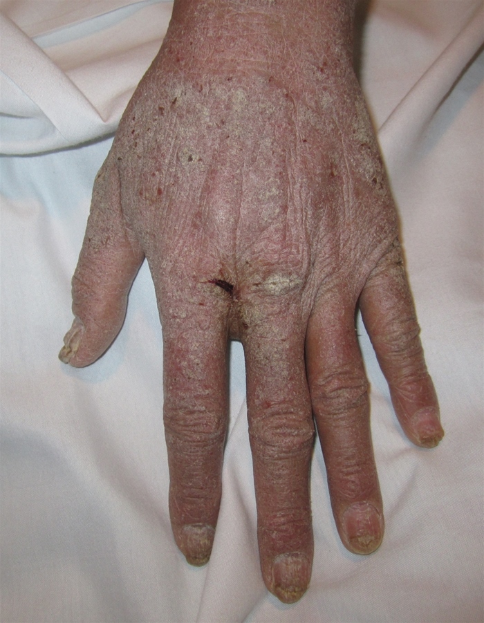 A 45-year-old man with known HIV infection comes to the emergency department due to a rash that began on his hands 4-5 weeks ago but then spread to involve his upper arms, shoulders, and ears.  He has no fever, trauma, recent travel, or insect bites.  He lives in a shelter and has poor medical follow-up.  The patient was treated in the past for Candida esophagitis and Pneumocystis jirovecii pneumonia.  His CD4<sup>+</sup> cell count 6 months ago was 50/µL.  His temperature is 36.7 C (98 F) , blood pressure is 126/80 mm Hg, and pulse is 80/min.  Photographs of the patient's skin examination are shown below.         Which of the following is the most likely diagnosis? A) Crusted scabies B) Eczema C) Psoriasis D) Seborrheic dermatitis E) Tinea corporis