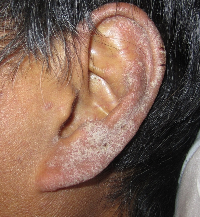 A 45-year-old man with known HIV infection comes to the emergency department due to a rash that began on his hands 4-5 weeks ago but then spread to involve his upper arms, shoulders, and ears.  He has no fever, trauma, recent travel, or insect bites.  He lives in a shelter and has poor medical follow-up.  The patient was treated in the past for Candida esophagitis and Pneumocystis jirovecii pneumonia.  His CD4<sup>+</sup> cell count 6 months ago was 50/µL.  His temperature is 36.7 C (98 F) , blood pressure is 126/80 mm Hg, and pulse is 80/min.  Photographs of the patient's skin examination are shown below.         Which of the following is the most likely diagnosis? A) Crusted scabies B) Eczema C) Psoriasis D) Seborrheic dermatitis E) Tinea corporis