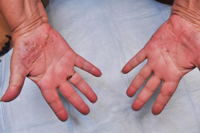 A 44-year-old man comes to the emergency department due to a diffuse, painful skin rash that began abruptly 2 days ago.  He has also had fever and malaise but no cough, shortness of breath, abdominal pain, diarrhea, dysuria, or joint pains.  Three years ago, the patient was diagnosed with plaque psoriasis involving the scalp, elbows, and knees.  He was treated with a high-potency topical corticosteroid ointment, which has improved his symptoms.  He stopped using the ointment a week ago.  He also has a history of untreated chronic hepatitis C.  The patient is sexually active and uses condoms inconsistently. Temperature is 38.7 C (101.8 F) , blood pressure is 130/70 mm Hg, and pulse is 98/min.  There is no scleral icterus or lymphadenopathy.  Oropharyngeal mucous membranes are normal.  Skin examination reveals erythema and lesions as shown below involving his trunk, neck, and extremities.   Which of the following is the most likely diagnosis? A) Acute pustular psoriasis B) Disseminated gonococcal infection C) Generalized herpes simplex virus infection D) Staphylococcal skin infection E) Toxic epidermal necrolysis