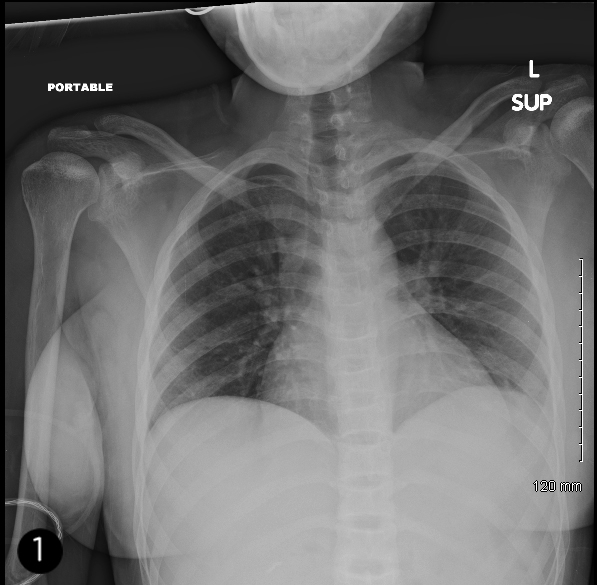 A 20-year-old African American woman with sickle cell disease comes to the emergency department with complaints of severe generalized body pain for 1 day.  She has been hospitalized for similar episodes in the past.  Her medications include folic acid, hydroxyurea, and hydrocodone as needed for pain. After initial evaluation, including pertinent laboratory studies and chest x-ray, she is started on 1/2 normal saline at 125 mL/hr and hydromorphone every 3 hours.  Over the next 36 hours, the patient complains of worsening chest pain and mild shortness of breath.  Her temperature is 38.9 C (102 F) , pulse is 112/min, and respirations are 23/min.  Oxygen saturation is 93% on 2 L O<sub>2</sub>.  Lung examination shows bilateral crackles.  Lower-extremity examination shows tenderness with palpation. Laboratory results are as follows:   She has good urine output.  Her chest x-ray on admission (Image 1)  and repeat x-ray after 36 hours (Image 2)  are shown below.     Which of the following, if instituted on initial presentation, may have helped prevent the clinical worsening that occurred in this patient? A) Antibiotic prophylaxis B) Hydromorphone PCA pump C) Incentive spirometry D) Inhaled bronchodilators E) Stringent use of intravenous hydration