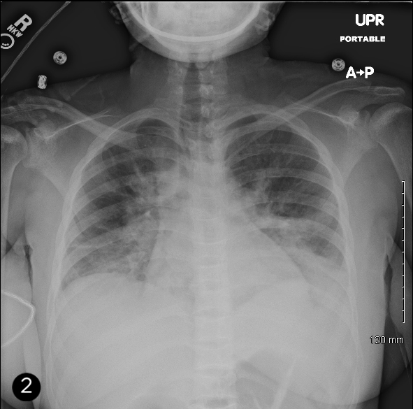 A 20-year-old African American woman with sickle cell disease comes to the emergency department with complaints of severe generalized body pain for 1 day.  She has been hospitalized for similar episodes in the past.  Her medications include folic acid, hydroxyurea, and hydrocodone as needed for pain. After initial evaluation, including pertinent laboratory studies and chest x-ray, she is started on 1/2 normal saline at 125 mL/hr and hydromorphone every 3 hours.  Over the next 36 hours, the patient complains of worsening chest pain and mild shortness of breath.  Her temperature is 38.9 C (102 F) , pulse is 112/min, and respirations are 23/min.  Oxygen saturation is 93% on 2 L O<sub>2</sub>.  Lung examination shows bilateral crackles.  Lower-extremity examination shows tenderness with palpation. Laboratory results are as follows:   She has good urine output.  Her chest x-ray on admission (Image 1)  and repeat x-ray after 36 hours (Image 2)  are shown below.     Which of the following, if instituted on initial presentation, may have helped prevent the clinical worsening that occurred in this patient? A) Antibiotic prophylaxis B) Hydromorphone PCA pump C) Incentive spirometry D) Inhaled bronchodilators E) Stringent use of intravenous hydration