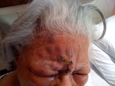 A 72-year-old woman comes to the emergency department for a rash on her forehead.  The rash has been present for 3 days and is getting worse.  She also complains of moderate frontal headache, malaise, and fever.  The patient has no neck pain, nausea, or vomiting.  She has not had similar symptoms before.  She is otherwise healthy and takes no medications. Her temperature is 38.5 C (101.3 F) .  Her forehead is shown in the photograph below.   In addition to admission to the hospital and intravenous acyclovir, which of the following is the best next step in management of this patient? A) Gabapentin B) Lumbar puncture C) Ophthalmology consult D) Oral prednisone E) Topical capsaicin