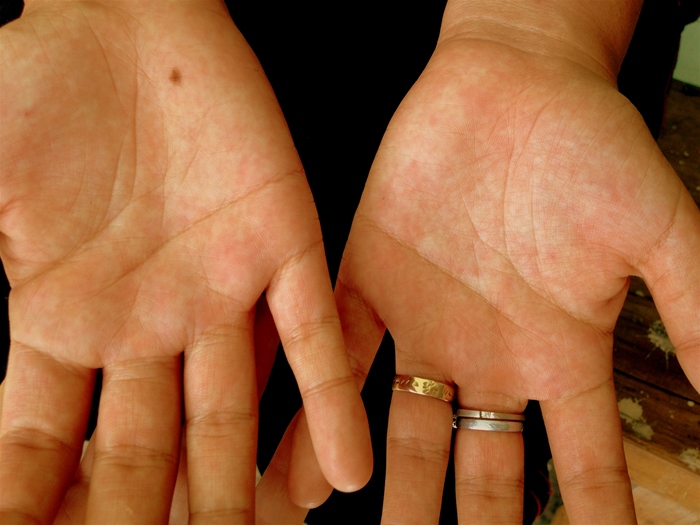 A 23-year-old woman comes to the emergency department after an episode of syncope.  She began feeling unwell 6 days ago with fever, throbbing pain behind the eyes, diffuse myalgias, and abdominal pain.  Her fever improved 2 days ago, but she noticed an erythematous skin rash developing on her trunk and upper and lower extremities.  A few hours prior to admission, the patient had an episode of epistaxis and a syncopal episode when cleaning the bathroom.  She has no other medical problems.  She returned from a trip to southern Mexico 10 days ago and states that one of her travel companions also has had fevers and myalgias.  The patient received the typhoid vaccine before her trip. Her temperature is 37.2 C (99 F) , blood pressure is 86/60 mm Hg, pulse is 108/min, and respirations are 14/min.  Examination shows mild abdominal tenderness with no hepatosplenomegaly.  Examination of the hands is shown below.   Laboratory studies are as follows:   Urinalysis is normal.  Which of the following is the most likely diagnosis? A) Dengue fever B) Epstein-Barr virus infection C) Leptospirosis D) Secondary syphilis E) Typhoid fever