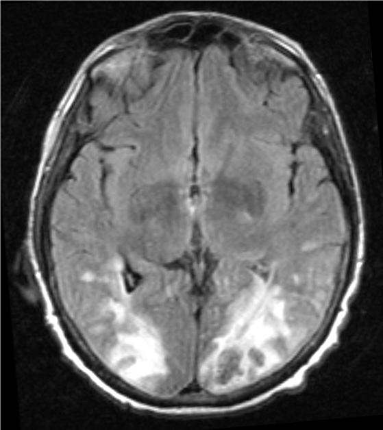 A 34-year-old woman is brought to the emergency department with acute onset of severe headache followed by generalized tonic-clonic seizures.  The patient was feeling well until 6 hours ago, when she developed a 10/10 throbbing bilateral headache associated with blurry vision.  Her headache is not exacerbated by change in head position, and nothing seems to improve the pain.  She denies any nausea, vomiting, photophobia, vertigo, fever, or neck pain.  She also denies any recent head or neck trauma.  She has had upper respiratory tract symptoms for the last couple of days. Her other medical problems include chronic migraines and non-essential hypertension related to renal artery stenosis from fibromuscular dysplasia.  Her medications include topiramate and multiple anti-hypertensive agents including amlodipine, hydrochlorothiazide, lisinopril, and metoprolol.  She also takes birth control pills and vitamins.  She has never had a seizure before and has no family history of epilepsy.  She works as a secretary and has smoked 2 packs of cigarettes daily for 10 years. Her temperature is 37 C (98.6 F) , blood pressure is 210/140 mm Hg, pulse is 80/min and regular, and respirations are 18/min with normal oxygen saturation.  The general physical examination is unremarkable, except for an abdominal bruit.  Neurological examination reveals that she is awake and alert, but is only oriented to person and place.  Funduscopic examination reveals copper and silver wiring in the retina without papilledema.  Pupils are equal, round, and reactive to light.  Visual acuity is 20/200 bilaterally with intact visual fields to confrontation.  There is no nystagmus and extra-ocular movements are full.  The remainder of the neurological examination is unremarkable. A non-contrast head CT showed hypodense regions with loss of grey-white matter differentiation in the posterior occipital-parietal lobes.  An MRI of the brain without gadolinium (shown below)  showed a symmetrical, increased T2/FLAIR signal abnormality in the subcortical white matter of the posterior occipital-parietal lobes.   Which of the following is the most likely diagnosis? A) Aneurysmal subarachnoid hemorrhage B) Herpes simplex encephalitis C) Idiopathic intracranial hypertension D) Migraine headache E) Posterior reversible encephalopathy syndrome