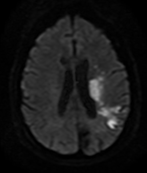 A 75-year-old man is brought to the emergency department due to right-sided weakness on awakening this morning. The patient has had no headache, nausea, double or blurry vision, or vertigo. Medical history includes type 2 diabetes mellitus, hypertension, and hyperlipidemia. Medications include metformin, lisinopril, and atorvastatin. Temperature is 36.7 C (98 F) , blood pressure is 168/96 mm Hg, pulse is 92/min, and respirations are 12/min. Physical examination reveals a carotid bruit on the left. Neurologic examination shows mild dysarthria, right central facial palsy, and mild right hemiparesis. ECG shows normal sinus rhythm. MRI of the brain reveals multiple acute cortical and subcortical infarcts in the left middle cerebral artery territory, as shown in the image below. CT angiography of the head and neck reveals 80%-90% stenosis at the origin of the left internal carotid artery. Echocardiogram shows mild left atrial enlargement, left ventricular hypertrophy, and left ventricular ejection fraction of 65%. The patient receives low-dose aspirin in the emergency department. Which of the following is the most appropriate next step in management of this patient? A) Carotid artery stenting within 2-4 months B) Carotid endarterectomy in 1-2 weeks C) Enoxaparin (therapeutic dose) for the duration of hospitalization D) Long-term warfarin therapy E) Nimodipine for 21 days