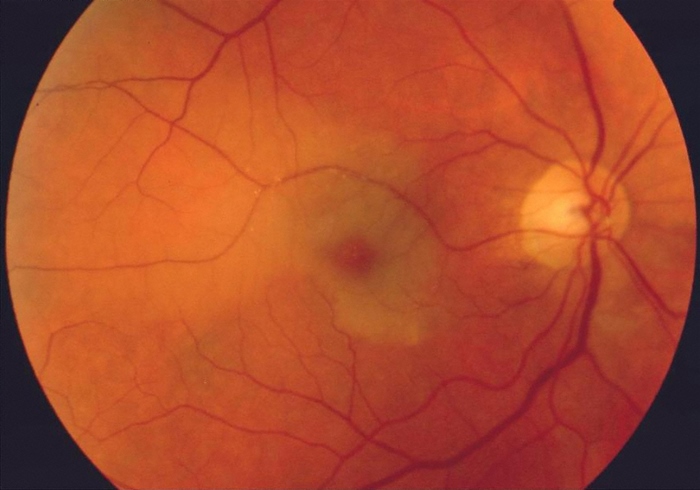 A 65-year-old woman comes to the emergency department with acute loss of vision in her right eye.  Three hours ago, she was watching television when she suddenly noticed the vision in her right eye become cloudy and then go completely black.  She has no headache, eye pain, double vision, dysarthria, dysphasia, muscle weakness, or numbness.  Past medical history includes type 2 diabetes mellitus and hypertension.  Her medications include lisinopril and metformin.  She has a 40-pack-year smoking history. Vital signs are within normal limits.  Visual acuity is 20/40 in the left eye and there is no light perception in the right eye.  There is a relative afferent pupillary defect on the right.  Ocular motility is normal on cardinal signs of gaze testing.  The remainder of the physical examination is within normal limits. Funduscopic examination is shown in the image below.   Which of the following is the most likely diagnosis for this patient's acute vision loss? A) Acute angle-closure glaucoma B) Central retinal artery occlusion C) Nonarteritic anterior ischemic optic neuropathy D) Optic neuritis E) Retinal detachment