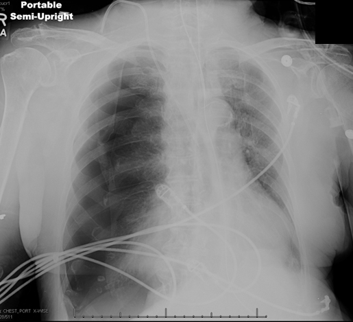 An 85-year-old nursing home resident is brought to the emergency department due to worsening cough, difficulty breathing, and decreased responsiveness for 3 days.  Medical conditions include hypertension, type 2 diabetes mellitus, and dementia.  Following evaluation that reveals leukocytosis and lung infiltrates, the patient's respiratory distress progressively worsens.  Endotracheal intubation is performed; mechanical ventilation is begun; the patient is given intravenous fluids and antibiotics; a central venous catheter is placed; and she is admitted to the intensive care unit (ICU) . In the ICU, the patient requires increasing ventilatory support with elevated airway pressures.  Temperature is 35.6 C (96 F) , blood pressure is 84/40 mm Hg, pulse is 112/min, and respirations are 16/min.  Pulse oximetry shows 92% on assist-control mode with a tidal volume of 300 mL, fraction of inspired oxygen (FiO<sub>2</sub>)  of 60%, and positive end-expiratory pressure (PEEP)  of 5 cm H<sub>2</sub>O.  Examination reveals decreased breath sounds on the right, rhonchi on the left, and normal S1 and S2.  The abdomen is soft and nontender.  There is no extremity edema. Arterial blood gases and chest x-ray are shown below.     Which of the following is the most appropriate next step in management of this patient? A) Increase the PEEP B) Insert chest tube C) Provide short-term neuromuscular paralysis D) Reposition the endotracheal tube E) Suction respiratory secretions