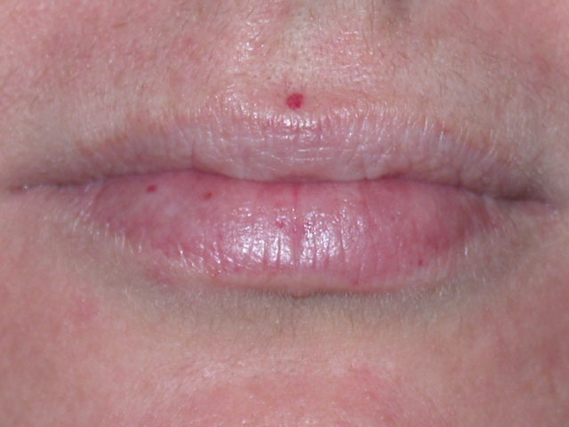 <strong>A 22-year-old woman is brought to the emergency department with confusion after a tonic-clonic seizure.  She has no prior history of seizures, headaches, or recent febrile illness.  The patient has suffered from recurrent nosebleeds for years with several visits to urgent care clinics for nasal packing.  She takes no medications. The patient's blood pressure is 134/85 mm Hg and pulse is 98/min.  She has no meningeal signs and moves all her extremities.  Deep-tendon reflexes are 2+ bilaterally. Laboratory results are as follows:   Additional physical examination findings are shown in the photograph below.   Which of the following is the most likely diagnosis?</strong> A)Hereditary hemorrhagic telangiectasia B)Hypersensitivity vasculitis C)Peutz-Jeghers syndrome D)Tuberous sclerosis E)von Willebrand disease <div style=padding-top: 35px> 