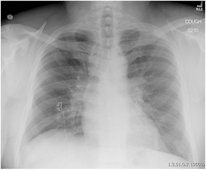 <strong>A 32-year-old African American man is admitted to the hospital due to dizziness.  For the past 2 weeks he has had decreased appetite, nausea, dry cough, constipation, and excessive urination.  He has had no fever or night sweats and was in good health prior to these symptoms.  The patient has no other medical problems and takes no medications.  He has 10-pack-year history of smoking.  He admits to drinking a few beers on weekends but does not use illicit drugs. His blood pressure is 110/70 mm Hg and pulse is 110/min.  Lung examination shows normal breath sounds.  The remainder of the examination is normal. Laboratory results are as follows:   Chest x-ray is shown below.   In addition to intravenous fluids, which of the following medications is most appropriate for this patient?</strong> A)Calcitonin B)Cinacalcet C)Furosemide D)Prednisone E)Zoledronate <div style=padding-top: 35px> 