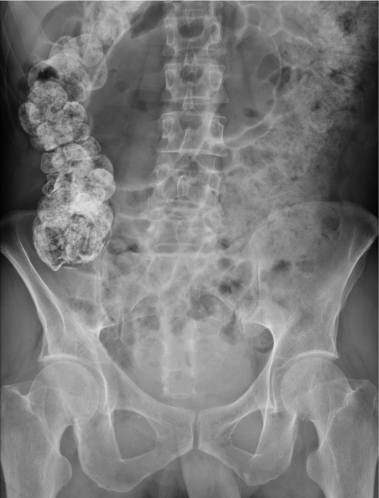 An 83-year-old man with mild cognitive impairment is transported from an assisted living facility with a 2-day history of abdominal pain and decreased oral intake.  He has no vomiting, fever, or urinary symptoms.  He underwent coronary artery bypass grafting 6 years ago.  The patient also had a stent placed in his superficial femoral artery 3 years ago for claudication due to peripheral artery disease. His temperature is 37.3° C (99.2° F) , blood pressure is 127/77 mm Hg, and pulse is 102/min.  He appears uncomfortable.  Examination shows dry membranes.  The abdomen is distended, diffusely tender, and tympanic to percussion.  There is no rebound tenderness or rigidity. Laboratory results are as follows:   Contrast abdominal imaging, shown below, reveals a large, air-filled sigmoid colon with absence of air in the rectum.   Which of the following is the best next step in managing this patient? A) Flexible sigmoidoscopy B) Nasogastric suction and broad-spectrum antibiotics C) Oral lactulose D) Sodium phosphate enema E) Surgery