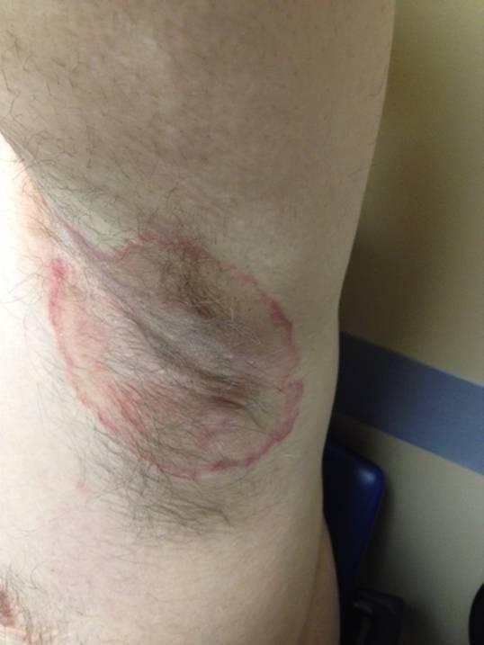 <strong>A 55-year-old man comes to the physician with an intensely pruritic rash under his left arm.  He has used an old prescription of 1% triamcinolone cream for the past 2 weeks without relief and believes that the rash is expanding.  The patient was diagnosed with Sjögren's syndrome 6 months ago when he developed dry eyes, dry mouth, and positive anti-SS-A and anti-SS-B antibodies.  Labial salivary gland biopsy at that time showed lymphocytic infiltration of salivary glands, confirming the diagnosis.  He was treated with hydroxychloroquine, topical moisturizing eye drops, and artificial saliva.  His other medical problems include type 2 diabetes mellitus, which has been well controlled with metformin.  Physical examination findings are shown in the image below.   Complete blood count and comprehensive metabolic panel are unremarkable.  His hemoglobin A1C is 6.1%. After confirming the diagnosis, which of the following is the most appropriate next step in management of this patient?</strong> A)Increase dose of oral hydroxychloroquine B)Increase potency of topical steroids C)Topical calcipotriene D)Topical clotrimazole E)Topical tacrolimus <div style=padding-top: 35px> 