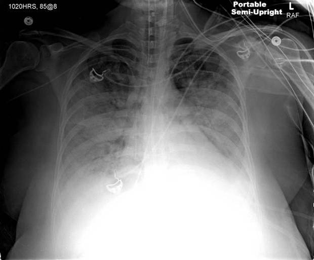 A 60-year-old woman is brought to the hospital for fever, chills, productive cough, and worsening shortness of breath.  These symptoms began 3 days ago but have worsened over the last 24 hours.  Her other medical problems include type 2 diabetes, hypertension, and psoriatic arthritis.  Her medications include methotrexate, metformin, glyburide, lisinopril, and hydrochlorothiazide.  She has a 20-pack-year smoking history. The patient's temperature is 39.3 C (102.7 F) , blood pressure is 110/70 mm Hg, pulse is 112/min, and respirations are 22/min.  Oxygen saturation is 90% on room air.  Examination shows mild respiratory discomfort with crackles over the right lower lung field.  The remainder of the examination shows no significant abnormalities. The patient is admitted to the hospital and started on intravenous antibiotics and normal saline at 150 mL/hr.  Over the next 12 hours, she develops worsening shortness of breath and hypotension requiring transfer to the intensive care unit.  Her blood pressure is 80/50 mm Hg, respirations are 36/min, and oxygen saturation is 82% on 100% oxygen.  She is intubated emergently.  Repeat chest x-ray, in the image below, shows diffuse bilateral airspace disease.  Laboratory results are as follows: pH 7.38, PaCO<sub>2</sub> 39 mm Hg, and PaO<sub>2</sub> 61 mm Hg on FIO<sub>2</sub> of 100%.   Which of the following is most likely to improve this patient's prognosis? A) High-frequency ventilation B) Low positive end-expiratory pressure C) Low tidal volume ventilation D) Maintenance of low PaCO<sub>2</sub> E) Use of inotropic agents with invasive cardiac output monitoring