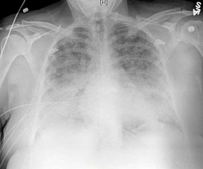 A 55-year-old man is evaluated for acute onset of respiratory distress.  He was admitted to the hospital after a highway traffic accident, which resulted in a left femur and wrist fracture.  He was immediately taken to the operating room and underwent open reduction and internal fixation.  The total blood loss was estimated at 1.1 liters and he was given 2 liters of intravenous normal saline and one unit of packed red blood cells intraoperatively.  He was extubated and transferred to the postoperative recovery room.  One hour following extubation, he developed acute respiratory distress requiring reintubation.  His other medical problems include inferior wall myocardial infarction with right coronary artery stent placement 3 years ago, hypertension, hyperlipidemia, and type 2 diabetes mellitus.  His home medications include aspirin, metoprolol, lisinopril, metformin, and rosuvastatin. His temperature is 38.1 C (100.6 F) , blood pressure is 110/70 mm Hg, pulse is 110/min, respirations are 30/min, and oxygen saturation is 90% on 100% FiO<sub>2</sub> and 10 mm Hg of PEEP.  He is drowsy from the sedation and intravenous hydromorphone infusion.  There is no jugular venous distention or lower extremity edema.  Pulmonary examination reveals diffuse crackles throughout the lungs.  There are no heart murmurs.  Skin examination reveals no rashes. Arterial blood gas shows a pH of 7.47, PaCO<sub>2</sub> of 32 mm Hg, and PaO<sub>2</sub> of 65 mm Hg. ECG shows sinus tachycardia.  His preoperative chest x-ray was within normal limits.  Repeat chest x-ray taken before reintubation is shown below.   Which of the following is the most likely cause of his current condition? A) Anaphylactic transfusion reaction B) Aspiration pneumonia C) Fat embolism D) Transfusion-associated acute lung injury E) Volume overload